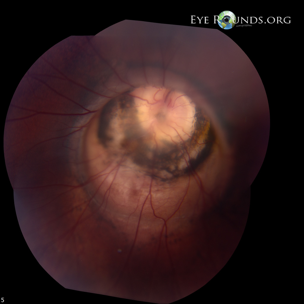 Atlas Entry Morning Glory Disc Anomaly with Peripapillary Staphyloma