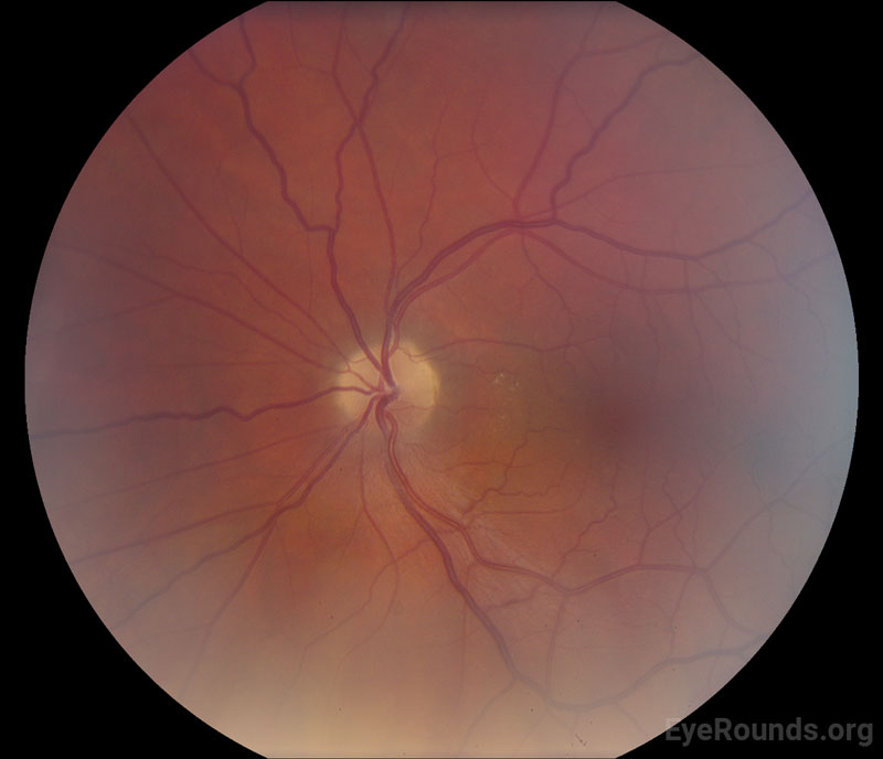 Atlas Entry Nonarteritic anterior ischemic optic neuropathy (NAION)