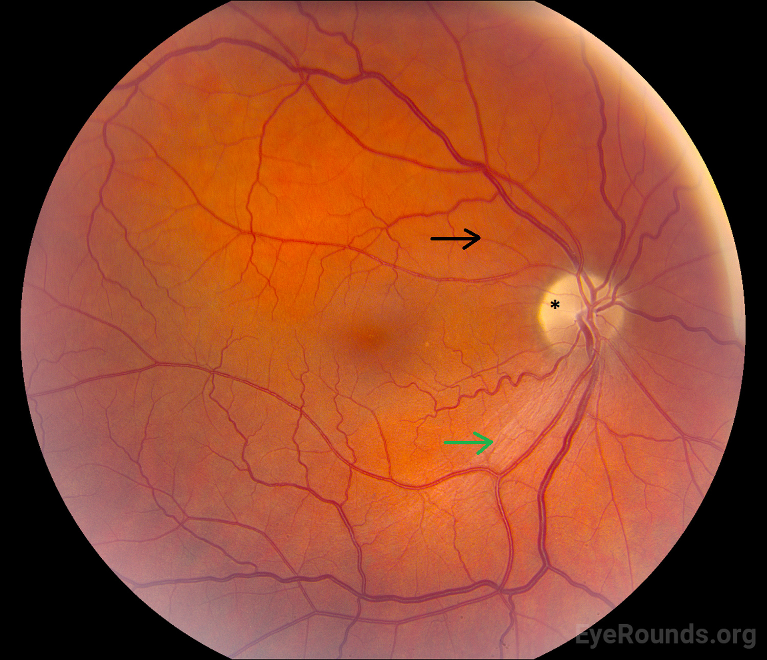 Atlas Entry Nonarteritic anterior ischemic optic neuropathy (NAION)