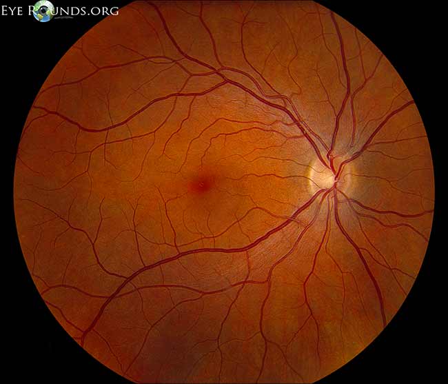 Diabetic Retinopathy for Medical Students. EyeRounds.org
