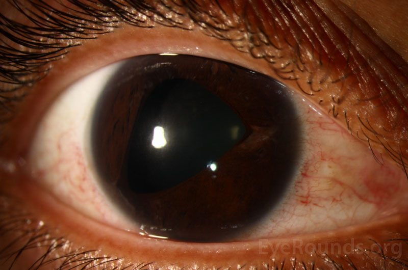 anterior segment of the right eye shows corectopia with the pupil drawn inferotemporally. 