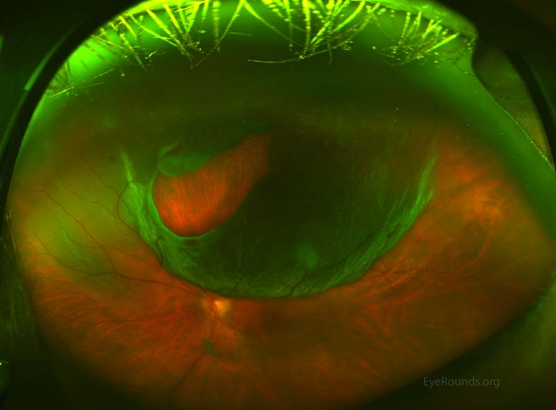 an excellent example of a large, superior horseshoe tear with a bullous retinal detachment. 