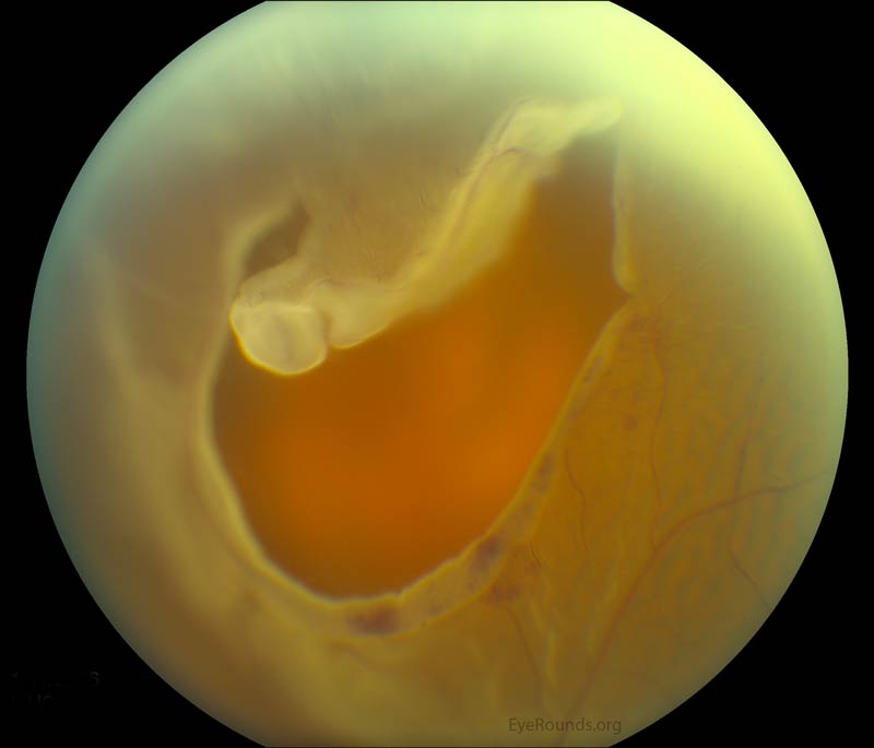 an excellent example of a large, superior horseshoe tear with a bullous retinal detachment. 