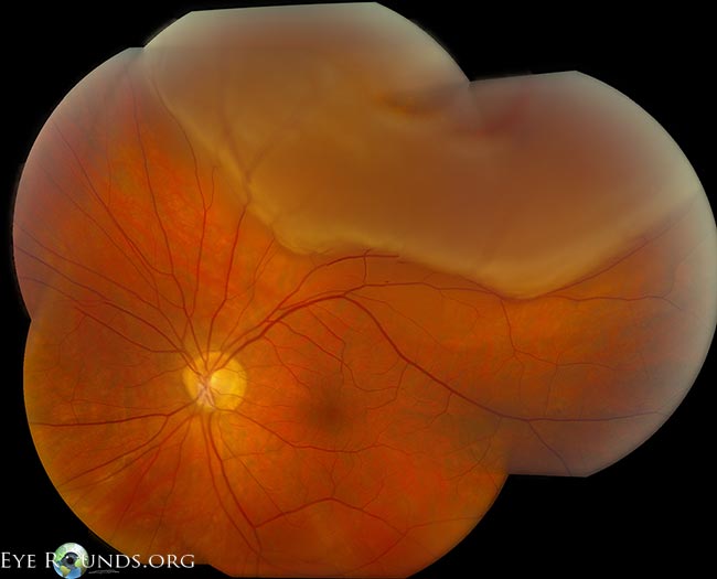 rhegmatogenous retinal detachment
