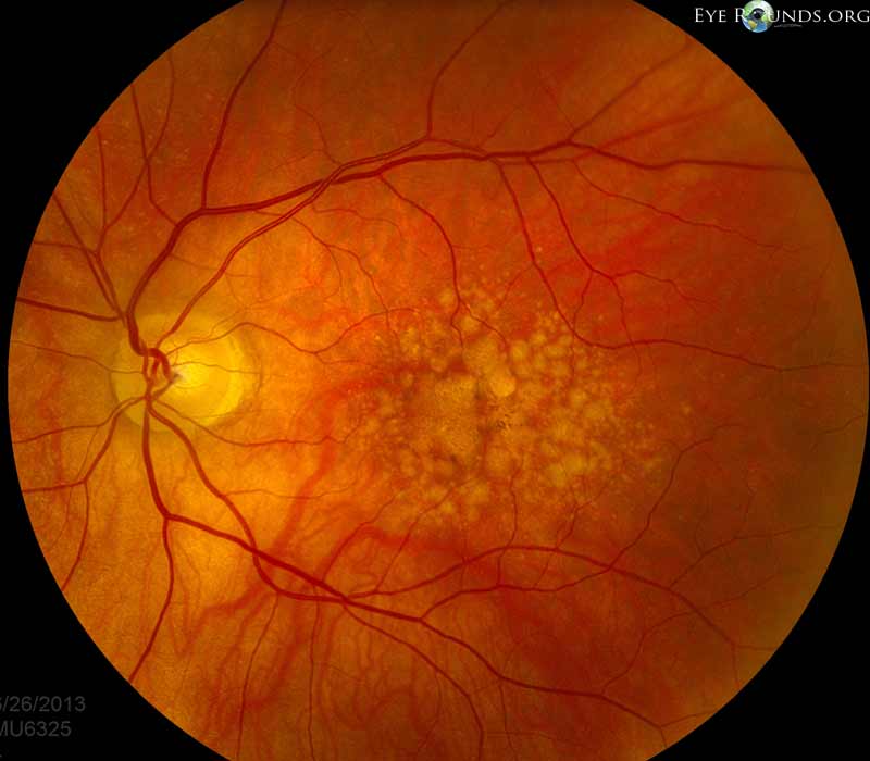 Retinal Detachment Patch Both Eyes
