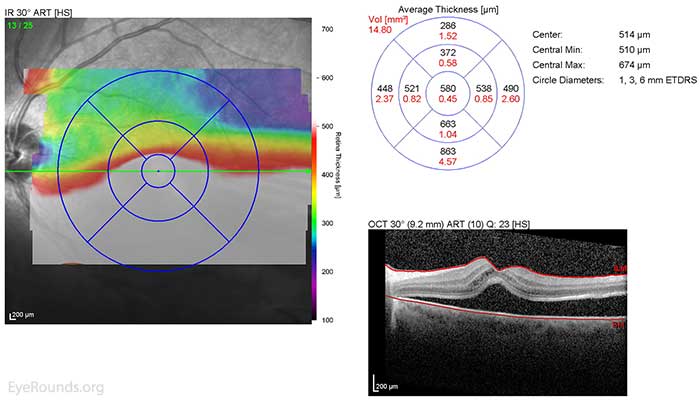 These OCT images show an inferior, macula-off, chronic rhegmatogenous retinal detachment. 