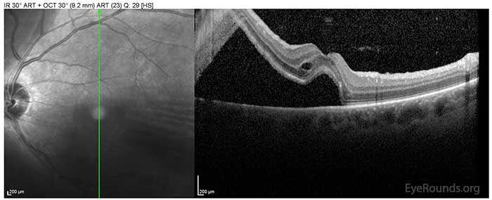 These OCT images show an inferior, macula-off, chronic rhegmatogenous retinal detachment. 