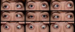 Aberrent Regeneration, 3rd Nerve Palsy