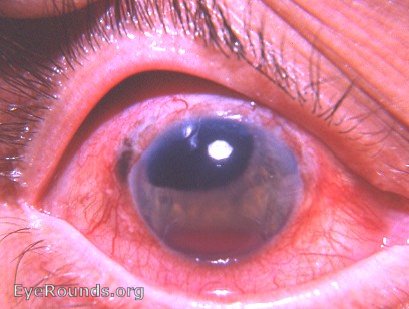 absolute glaucoma following extraction of subluxated cataract
