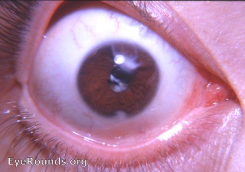 adherent leukoma with aftercataract and with needling scar at limbus at 6 o'clock.