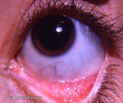 allergic follicular conjunctivitis