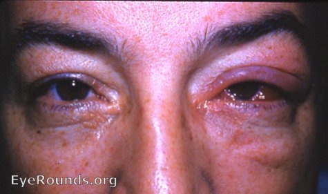 acute angular meibomitis ( meibomianitis ) with marked chemosis, lid edema, and pain OS