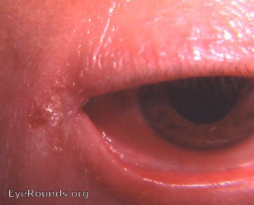 angular conjunctivitis OD