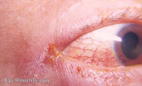 angular conjunctivitis