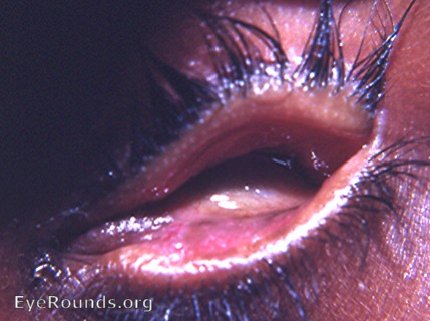 clinical anophthalmos - congenital