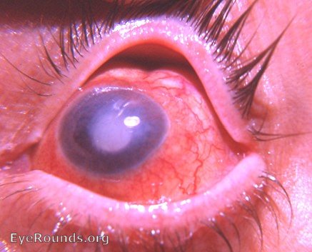 cataract: phthisis bulbi post cataract surgery