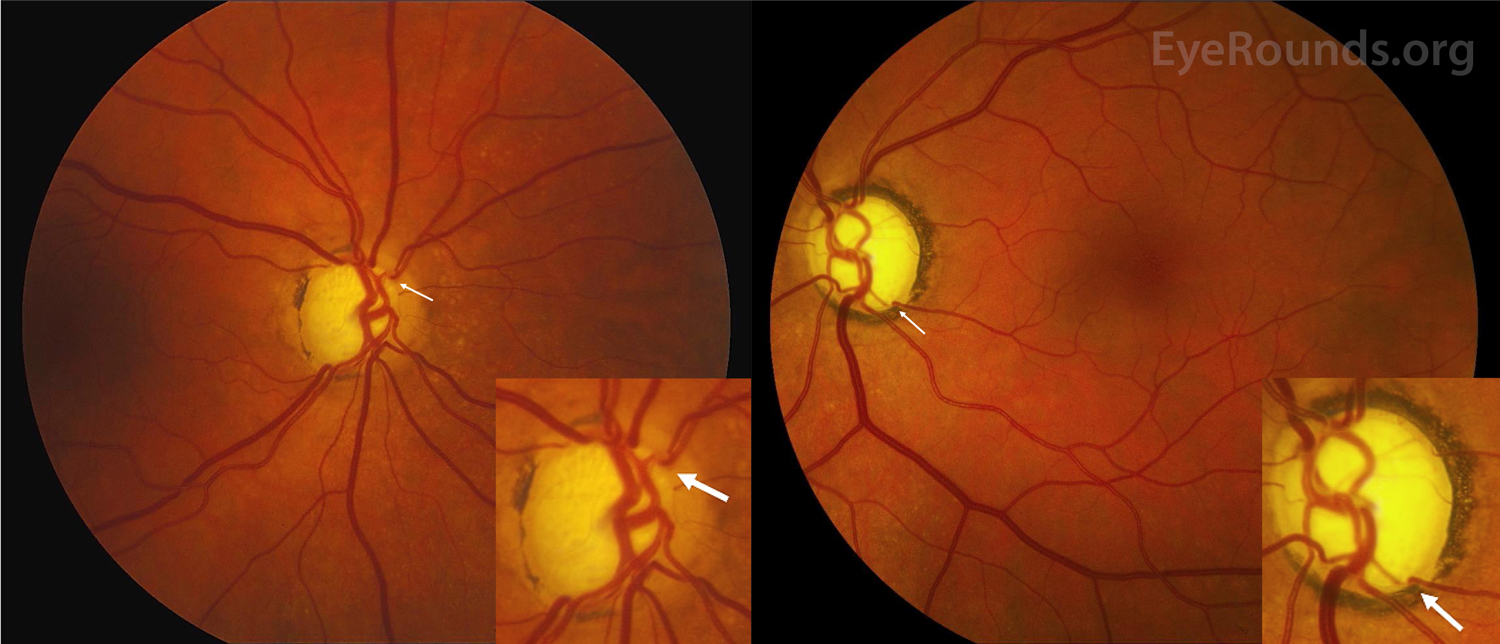 Bayoneting of vessels and bean-pot cupping in advanced glaucoma