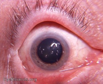 filamentary  keratitis - a second view