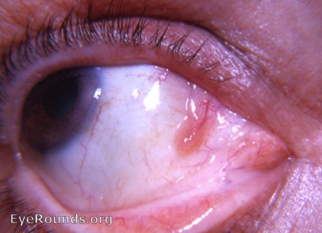 papiloma conjunctival