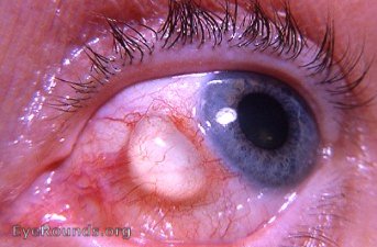bulbar conjunctival epithelial inclusion cyst