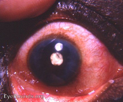 cataracta complicata et calcarea/ calcified complicated cataract