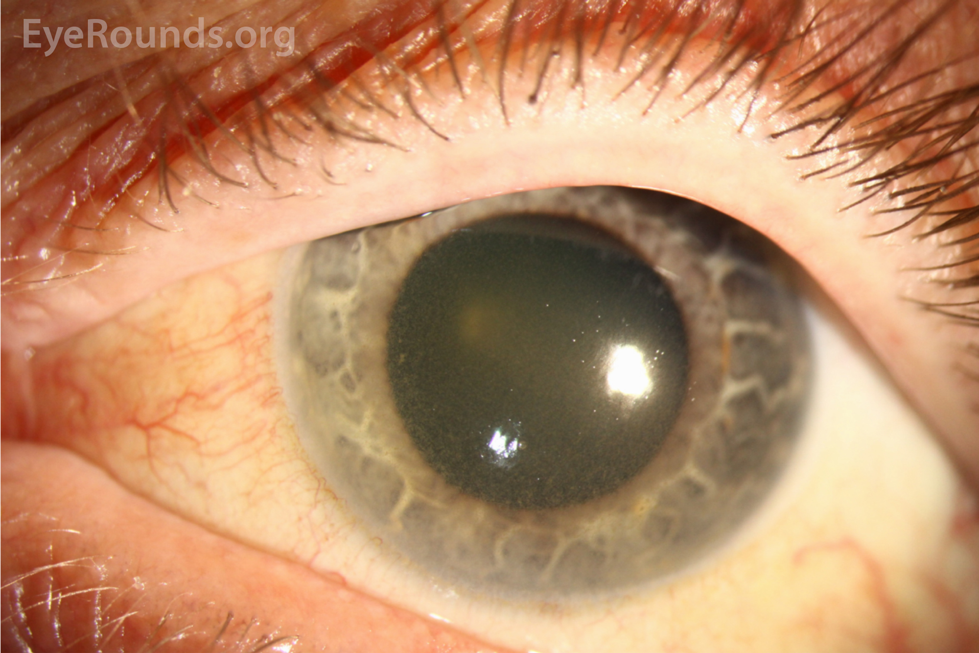 Corneal and lenticular pigmentation from longterm chlorpromazine use