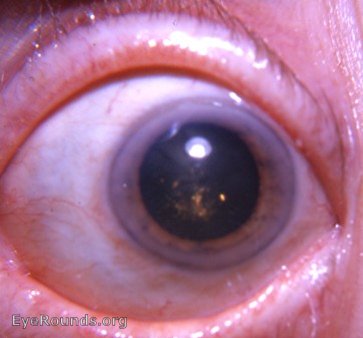 cataract: cholesterol crystals
