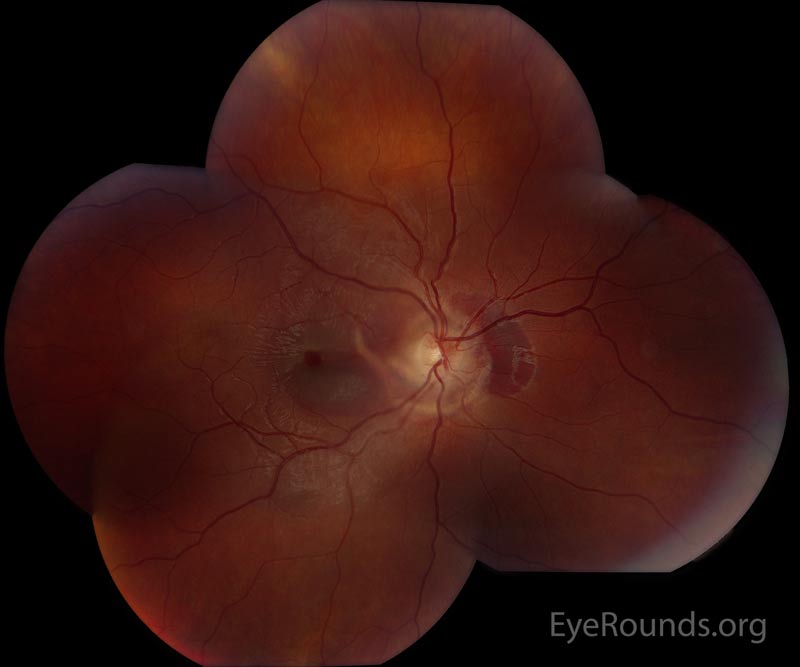 Choroidal rupture. Online Ophthalmic Atlas