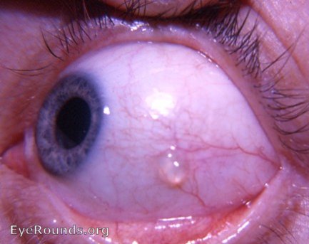 bulbar conjunctival lymph cyst