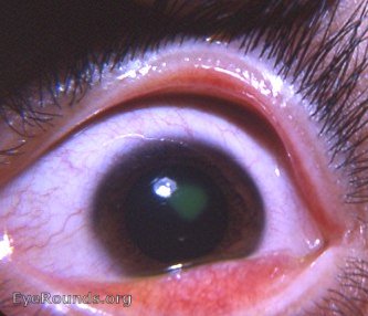 reaction to contact lens overwear