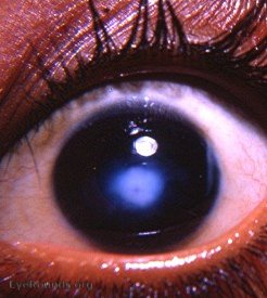 central corneal leukoma