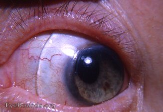 corneoscleral contact lens