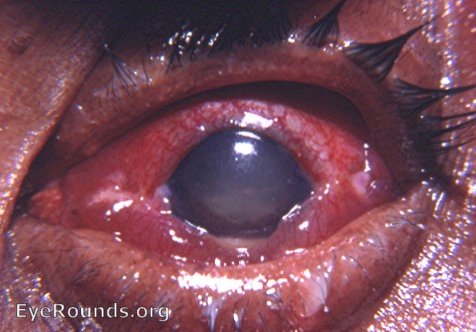 acute endophthalmitis during immediate post- cataract surgery