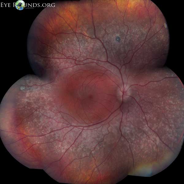 Enhanced Scone Syndrome. Online Atlas of Ophthalmology The
