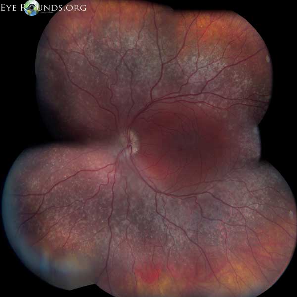 Enhanced Scone Syndrome. Online Atlas of Ophthalmology The