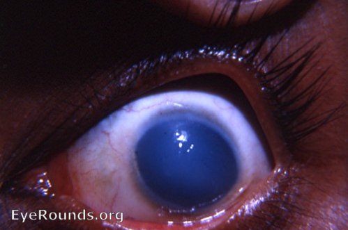 cornea: familial corneal epithelial dystrophy 