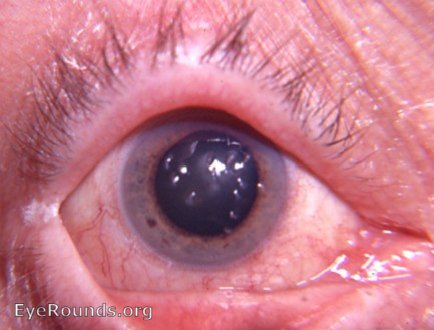 filamentary  keratitis - a second view