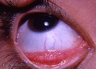 allergic conjunctivitis