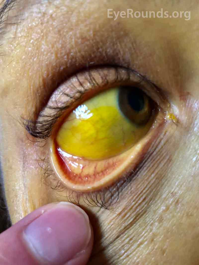 define scleral icterus define scleral icterus