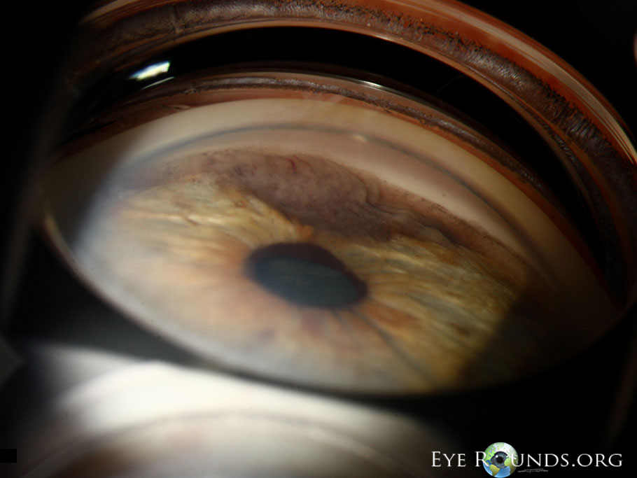 Iris Melanoma, gonioscopic view