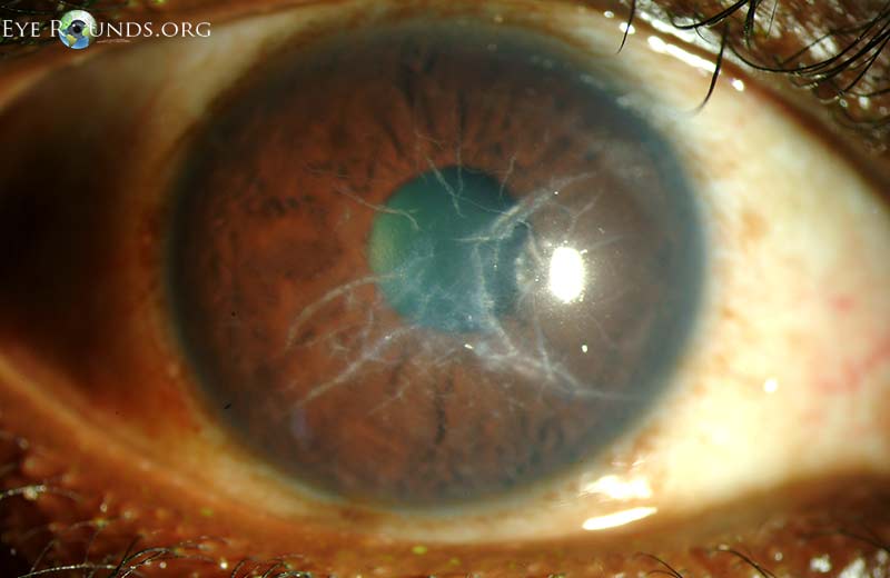 external photo of lattice corneal dystrophy