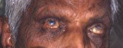 leprosy, uveitis, keratitis