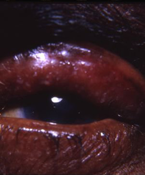 osteomyelitis fistula of frontal bone ( related to sinusitis ) with adherenco of skin of upperlid producing an ectropion with epidermalization of the exposed palpebral conjunctiva
