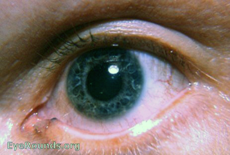 pigmented punctum lacrimalis OS