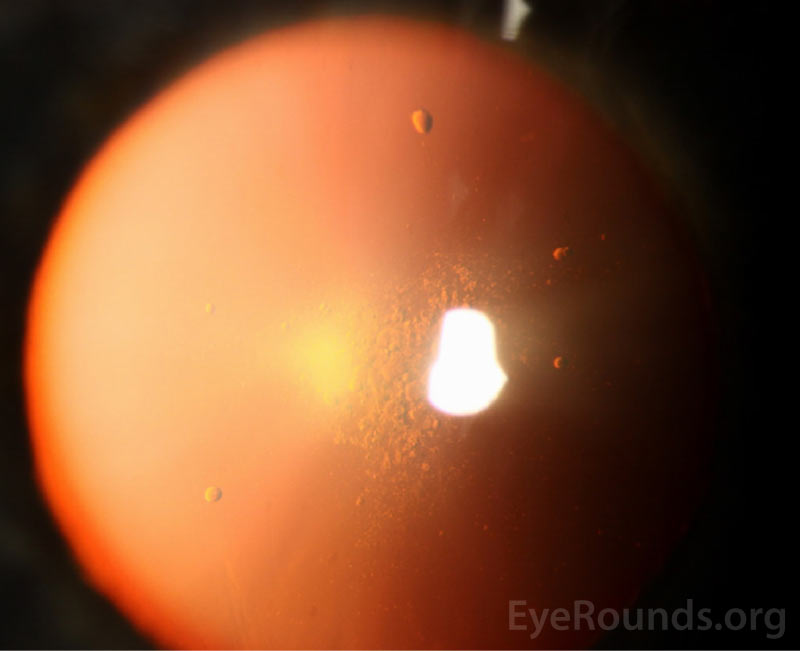 Thin fibrotic membrane on the posterior lens capsule.