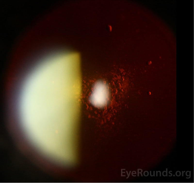 Thin fibrotic membrane on the posterior lens capsule.