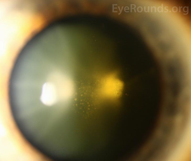 Thin fibrotic membrane on the posterior lens capsule.