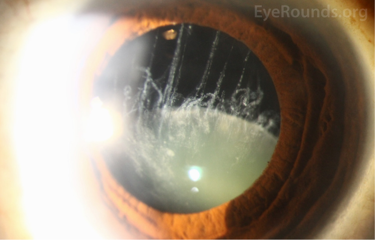 Atlas Entry Spontaneous Phakic Lens Dislocation in Pseudoexfoliation