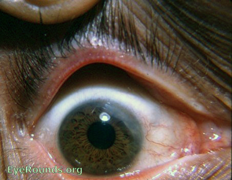 sclerosing keratitis