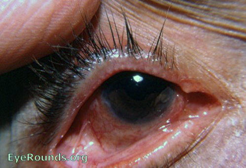 trachoma with symblepharon 